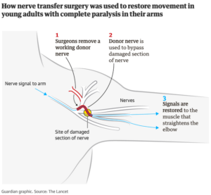 Nerve Transfer Methodology